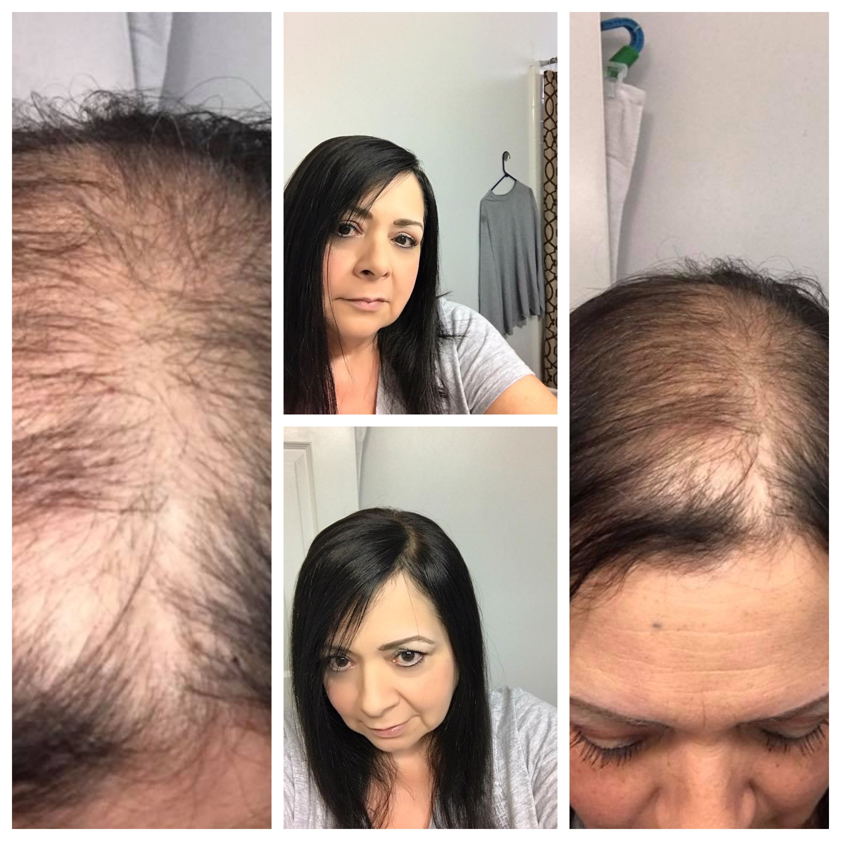 hair loss what to do